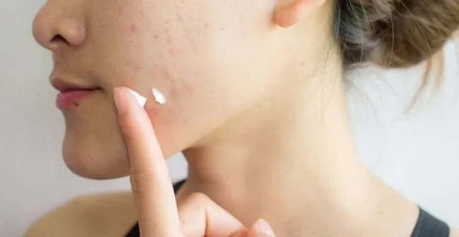 Những lưu ý khi chăm sóc da khô nổi mụn