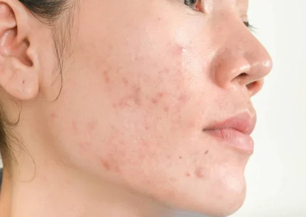 Tìm hiểu nguyên nhân khiến da khô sau điều trị mụn