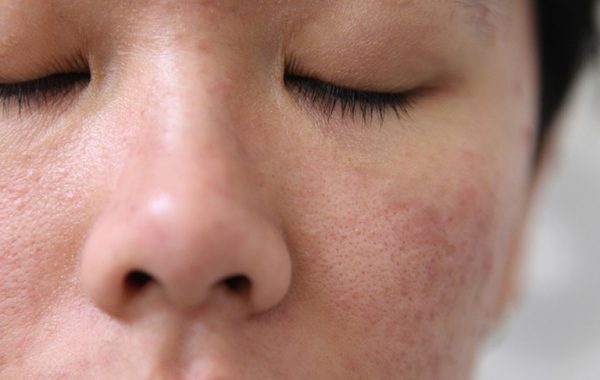 Hiểu rõ nguyên nhân để biết da mặt khô lỗ chân lông to phải làm sao