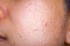 Hiểu rõ nguyên nhân da mặt sần sùi lỗ chân lông to