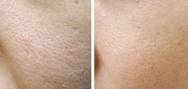 Tìm hiểu nguyên nhân để chọn kem trị lỗ chân lông to hiệu quả
