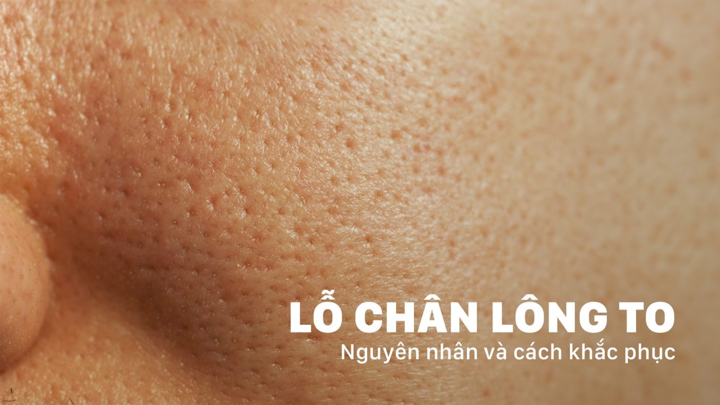 Tìm hiểu nguyên nhân và cách khắc phục lỗ chân lông to