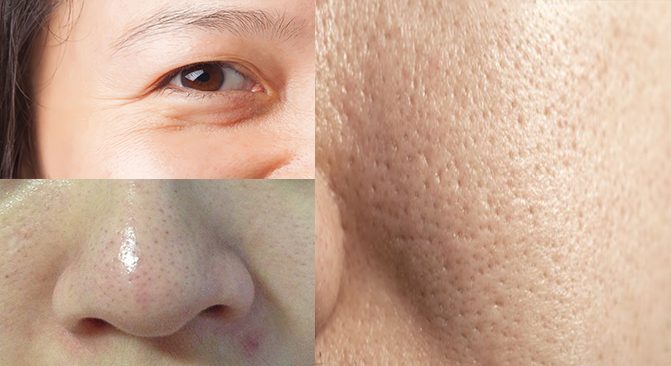 Lỗ chân lông to là như thế nào? Cách khắc phục lỗ chân lông to hiệu quả