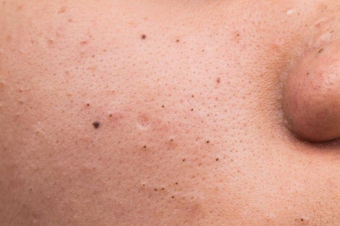 Lưu ý khi chăm sóc lỗ chân lông to mụn đầu đen
