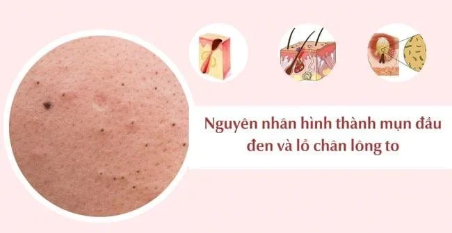 Nguyên nhân hình thành lỗ chân lông to mụn đầu đen