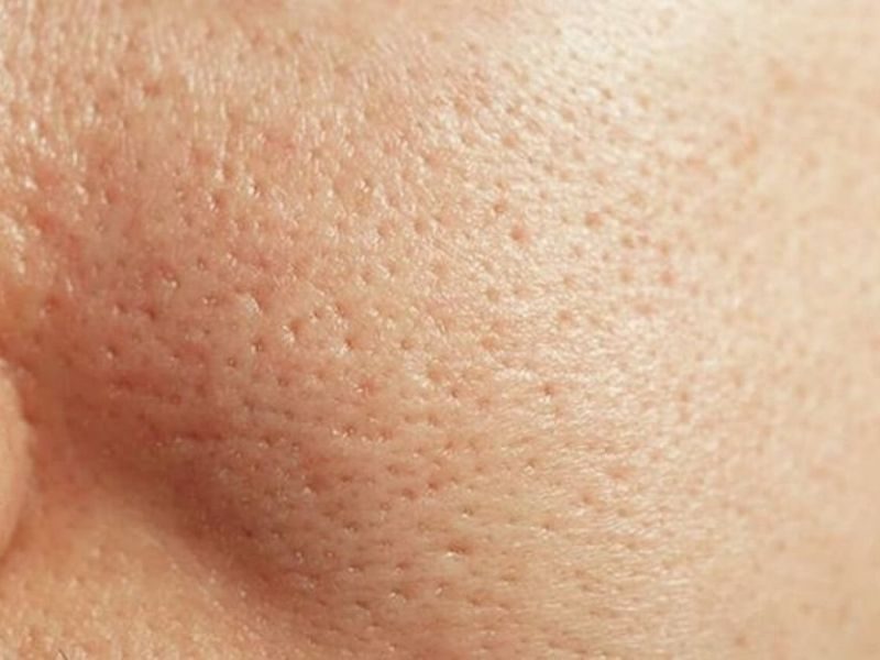 Hiểu rõ nguyên nhân lỗ chân lông to để biết lỗ chân lông to nên làm gì