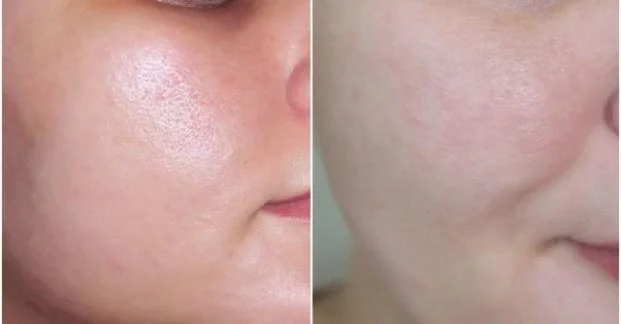 Hiểu rõ nguyên nhân để biết cách thu nhỏ lỗ chân lông to ở má