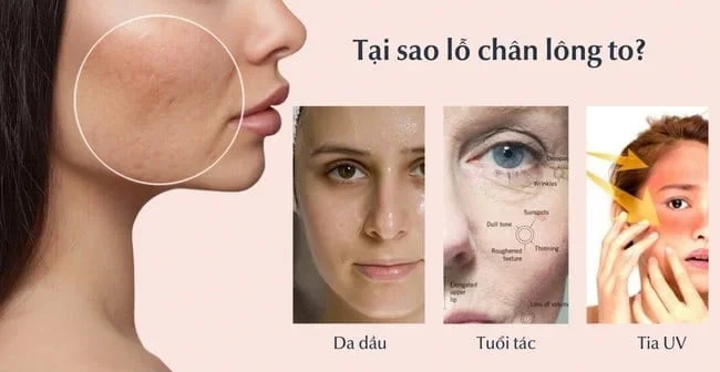 Lỗ chân lông to phải làm sao? Tìm hiểu nguyên nhân lỗ chân lông to