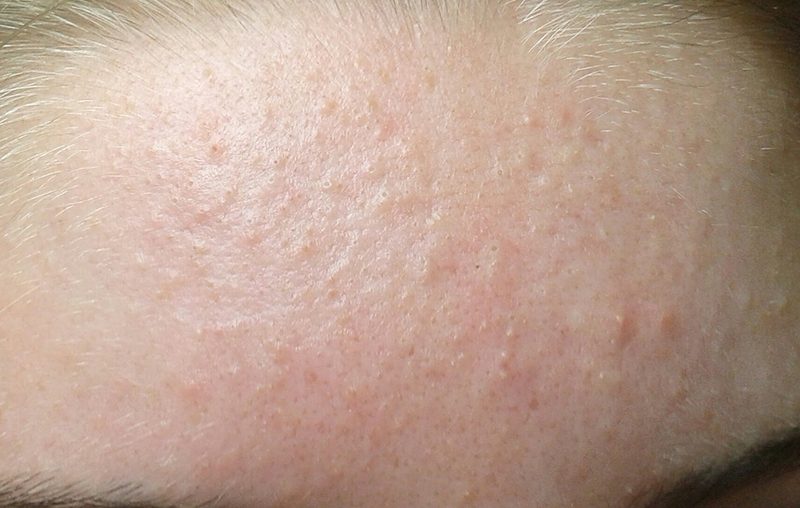 Tìm hiểu nguyên nhân da dầu nổi mụn ẩn