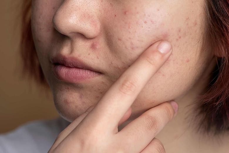 Lựa chọn mỹ phẩm sai cách là một trong những nguyên nhân da dầu nổi mụn ẩn
