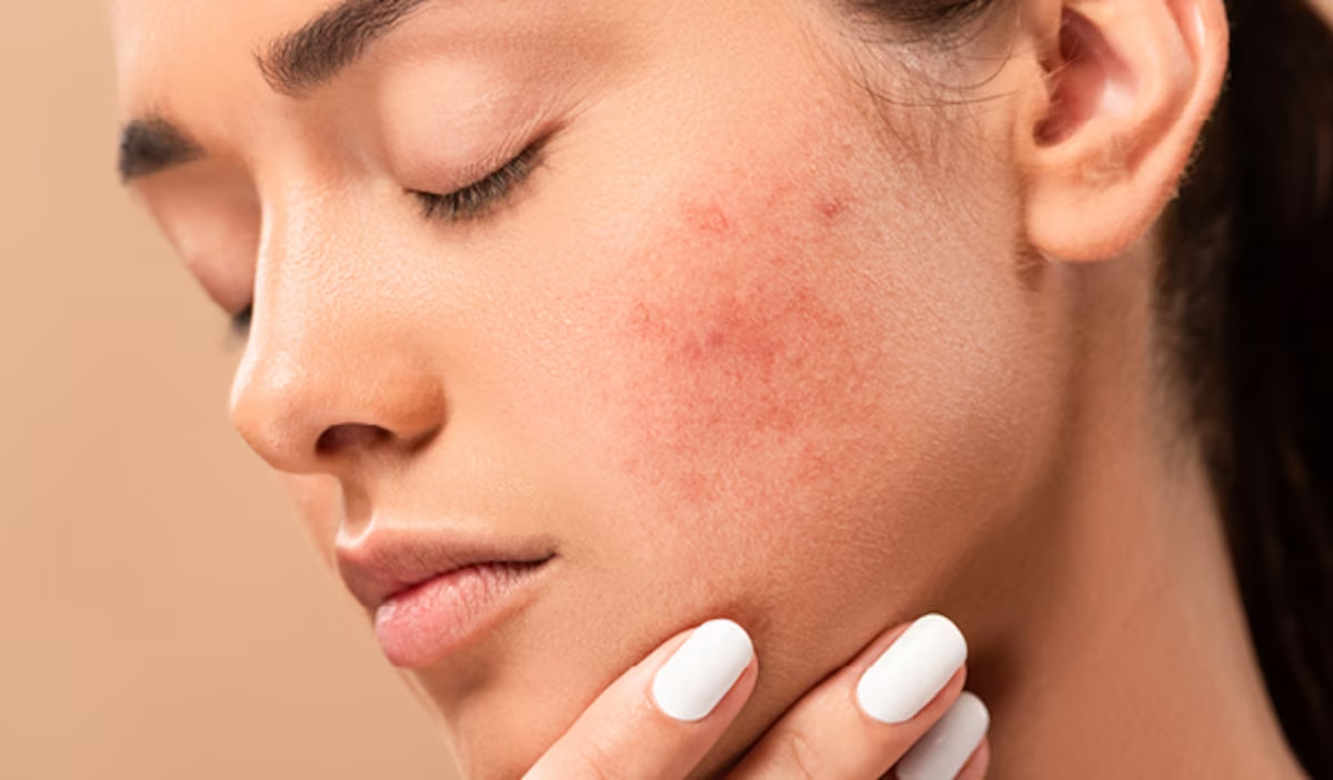 Hiểu rõ nguyên nhân da nhạy cảm bị kích ứng khi trời nắng và cách chăm sóc phù hợp
