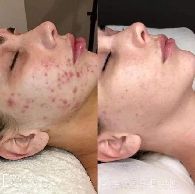 Peel da có nên làm vào mùa hè không? Peel da giúp cải thiện tình trạng dầu mụn mùa hè