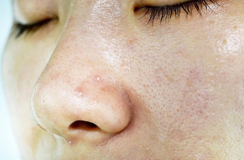 Tìm hiểu nguyên nhân để có routine chống lão hóa da dầu mụn hiệu quả