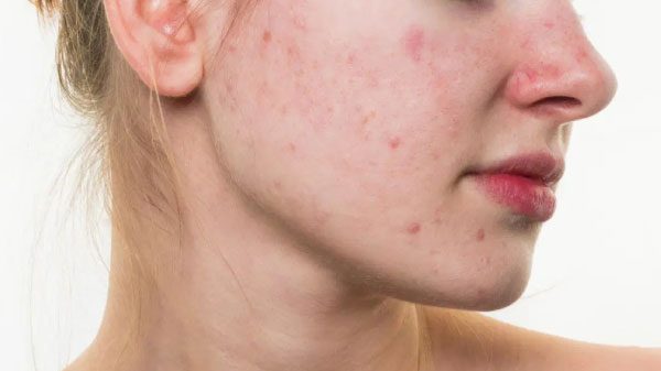 Lưu ý khi dùng sản phẩm cho da hỗn hợp