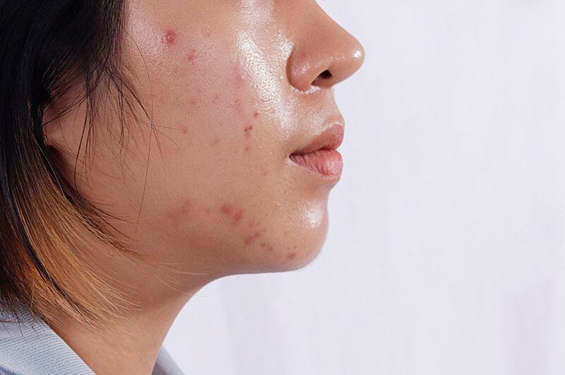 Các bước sử dụng sản phẩm skincare drugstore cho da dầu hiệu quả