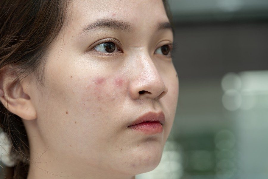 Những thành phần thường có khi skincare cho da dầu