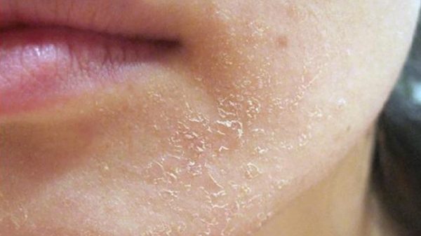 Tại sao da dầu vẫn bị khô? Một điều thú vị là da khô sẽ tự tiết dầu để bảo vệ da