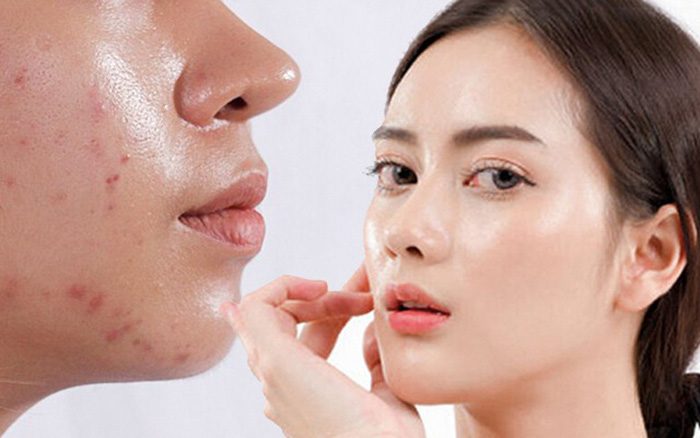 Tại sao nên dùng toner kiềm dầu cho da dầu mùa nóng