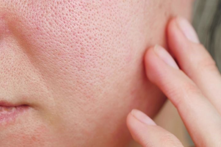 Những nguyên nhân khiến lỗ chân ở mặt ngày càng to