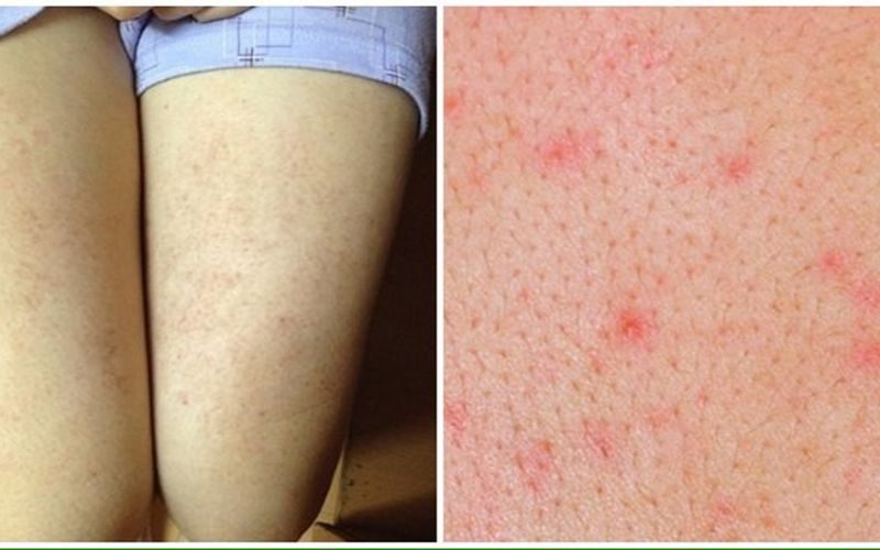 Cải thiện wax lông có làm to lỗ chân lông hiệu quả