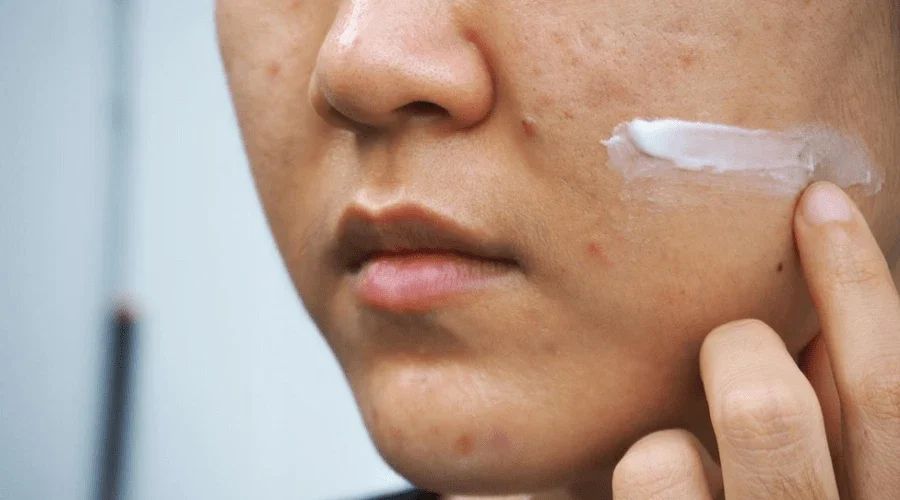 Adapalene có gây tác dụng phụ không? Những điều bạn cần biết