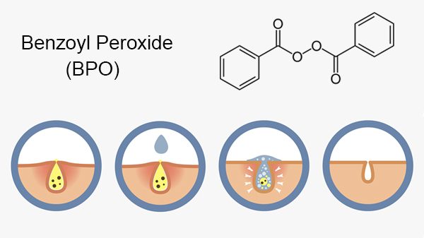 Benzoyl Peroxide là gì? Các dạng Benzoyl Peroxide trên thị trường