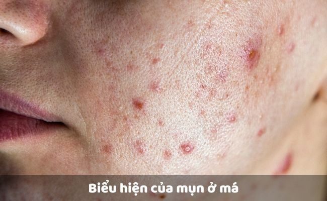 Nguyên nhân dẫn đến tình trạng bị mụn ở má