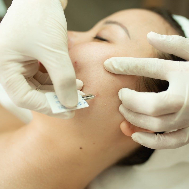 Cách phòng ngừa bị mụn ở má