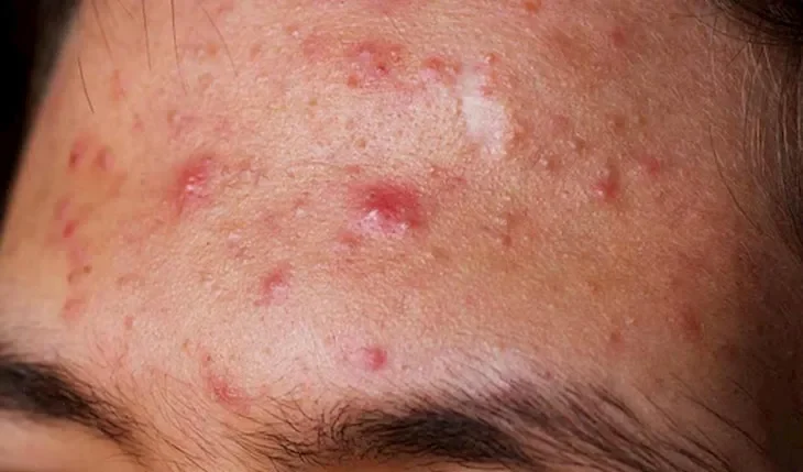 Tìm hiểu nguyên nhân để biết bị mụn viêm nên làm gì