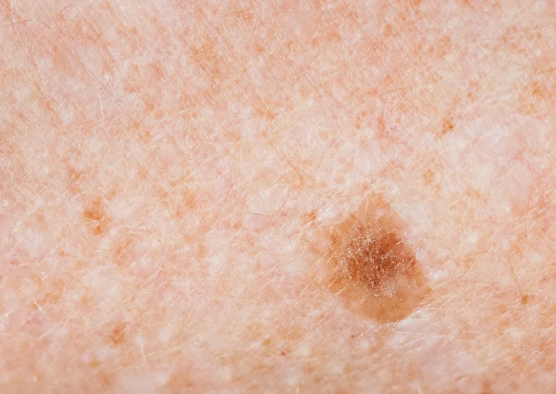Tìm hiểu nguyên nhân bị nổi đốm đen trên da
