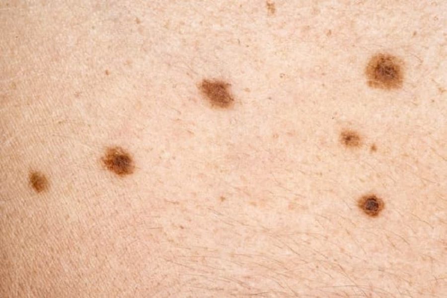 Phương pháp điều trị và chăm sóc da nổi đốm đen hiệu quả