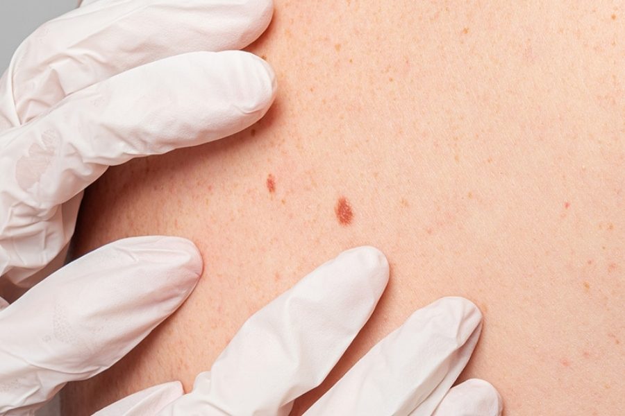 Những bệnh lý nguy hiểm có thể gây đốm đen