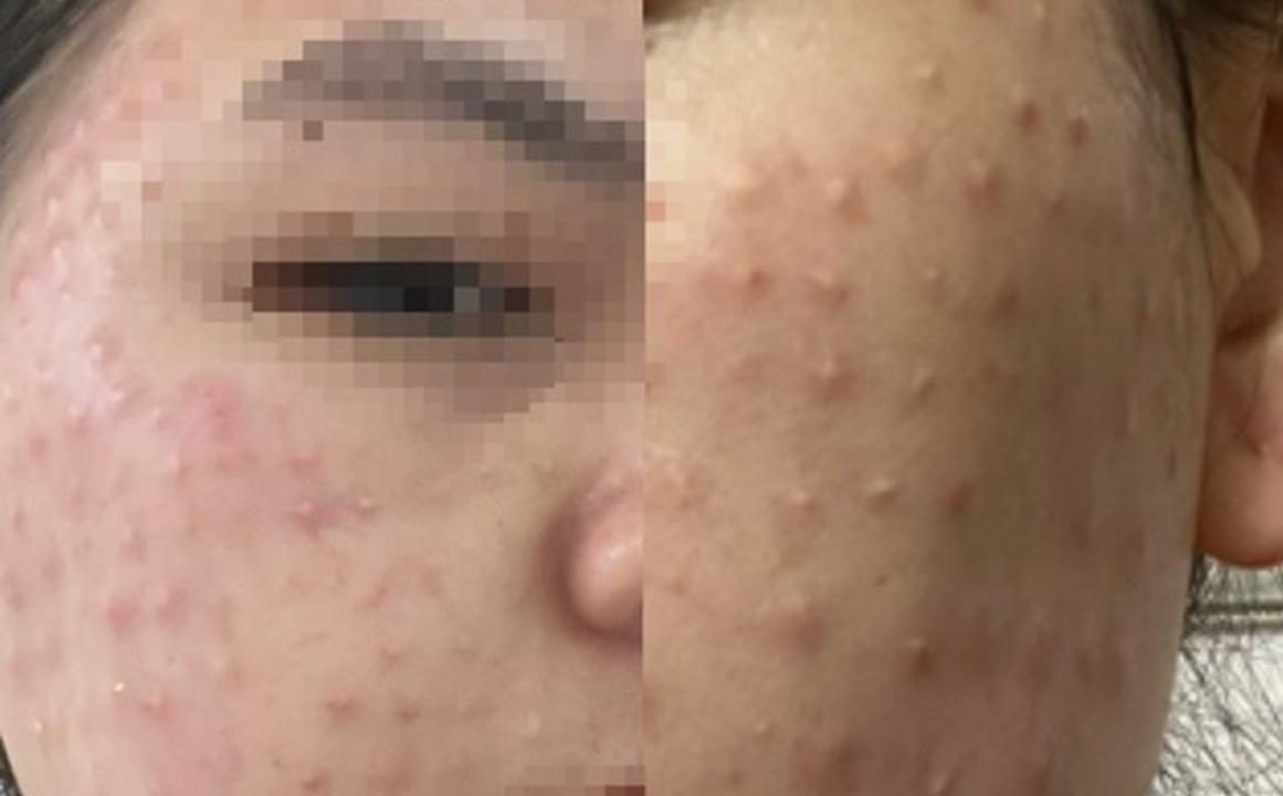 Tìm hiểu nguyên nhân gây biên chứng tiêm meso