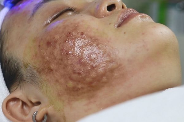 Những biến chứng tiêm meso phổ biến thường gặp