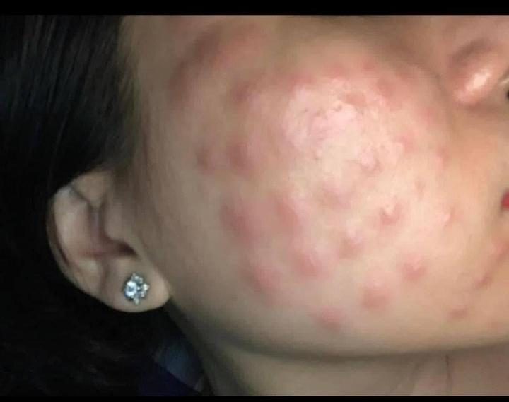 Phục hồi da sau tiêm meso, hạn chế biến chứng với sản phẩm Dr.Spiller