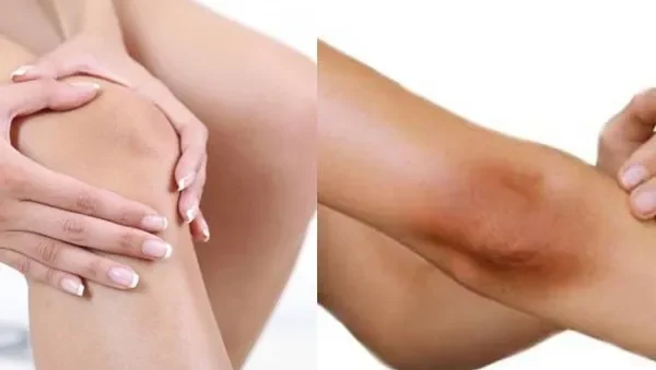 Các cách trị thâm đầu gối phổ biến hiện nay