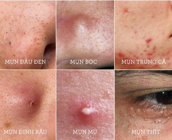 Phân loại các loại mụn trên mặt theo đặc điểm lâm sàng