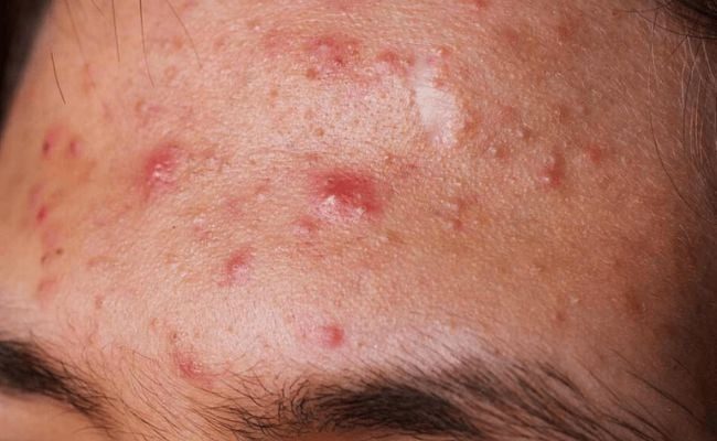 Giải pháp chăm sóc và điều trị hiệu quả từng loại mụn