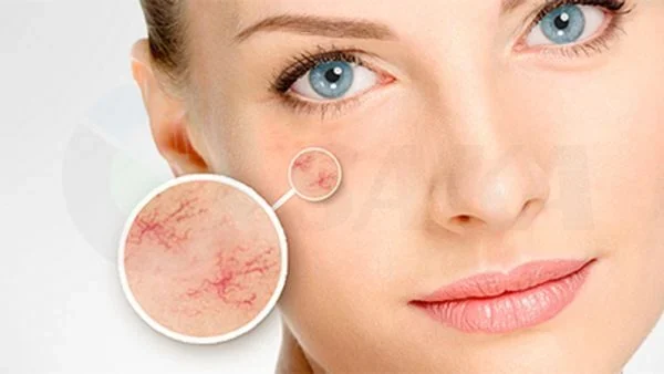 Giãn mao mạch không thể tự khỏi nên bạn cần tìm phương pháp chăm sóc phù hợp