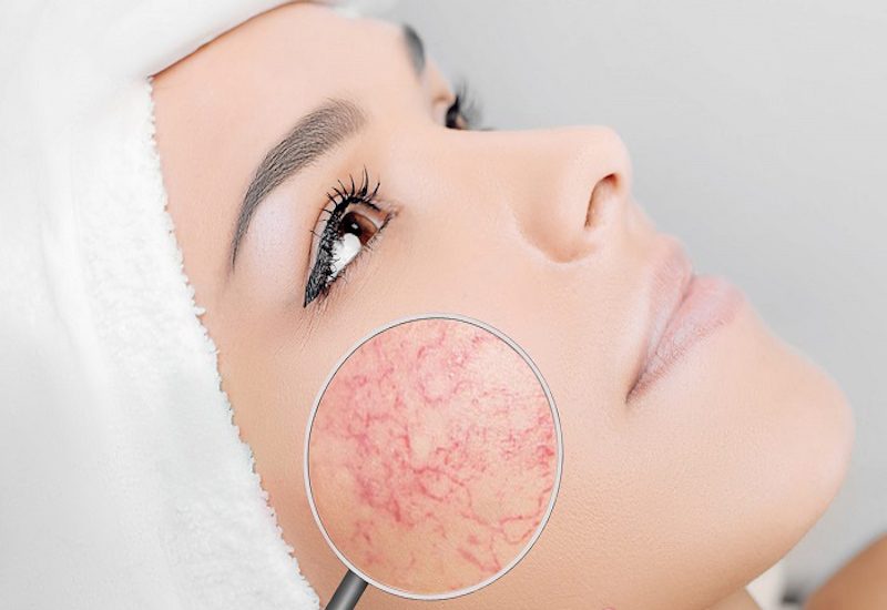 So sánh các phương pháp trị giãn mao mạch