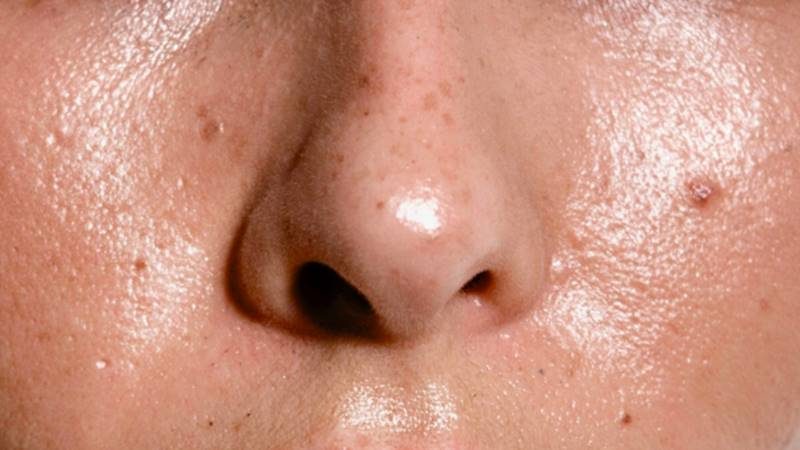 Hiểu rõ nguyên nhân để biết cách khắc phục da nhờn hiệu quả