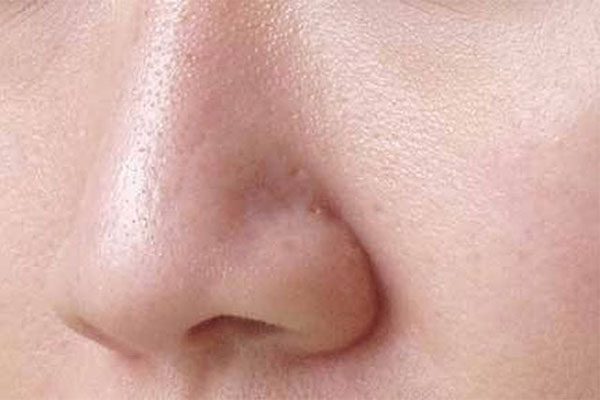 Những cách trị lỗ chân lông to phổ biến hiện nay