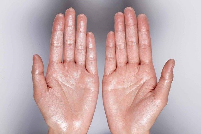 Tìm hiểu nguyên nhân để biết cách trị mồ hôi tay