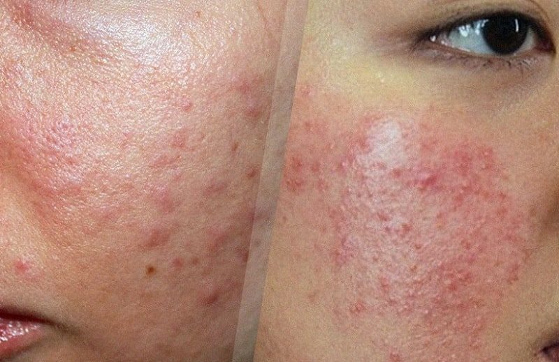 Mụn ẩn là gì và vì sao da nhạy cảm dễ bị mụn ẩn?