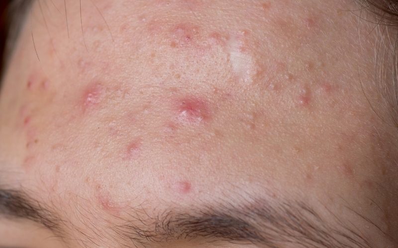 Tìm hiểu nguyên nhân để có cách trị mụn nội tiết hiệu quả