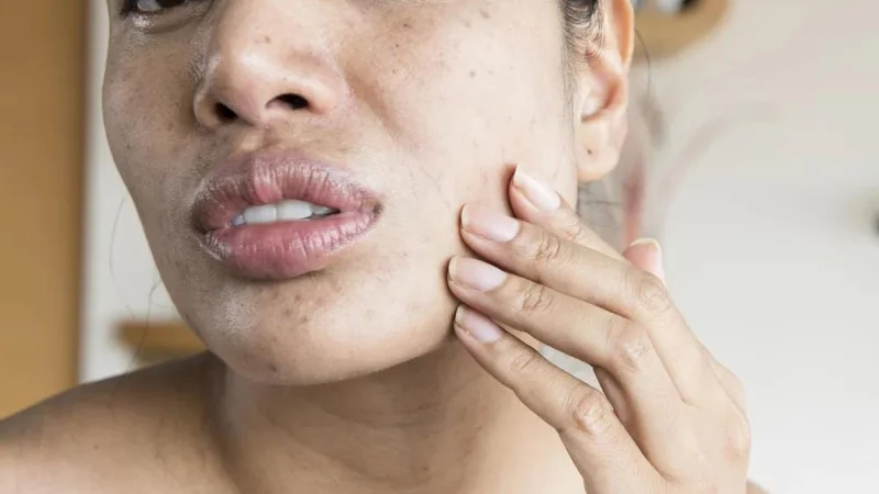 Nguyên nhân phổ biến gây ra cảm giác có con gì bò trên mặt