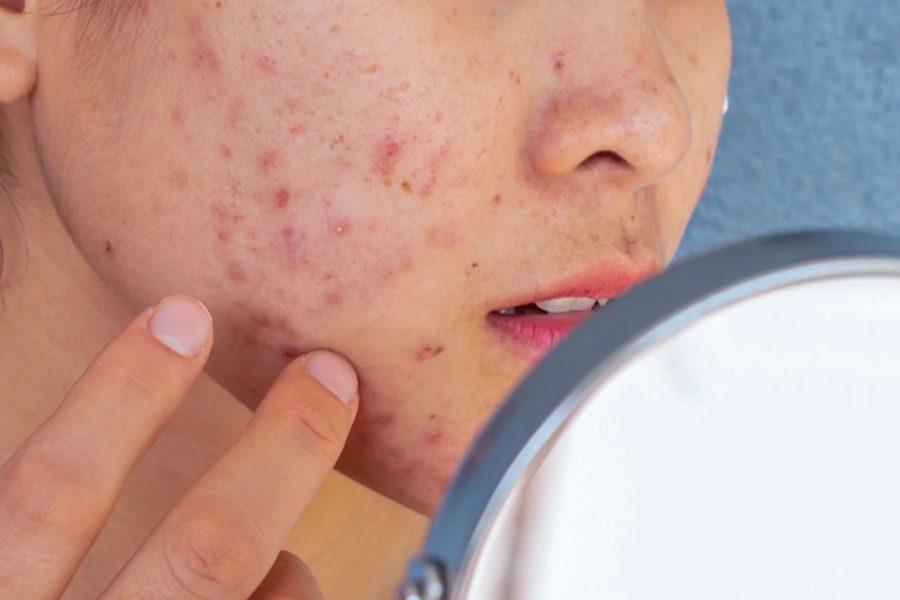 Hiểu đúng về làn da dầu mụn để chăm sóc da dầu mụn hiệu quả