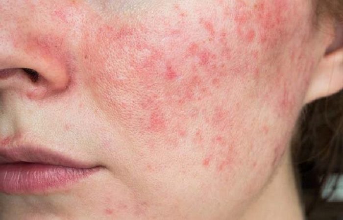 Chăm sóc da mặt mỏng nhạy cảm: Những nguyên tắc cơ bản