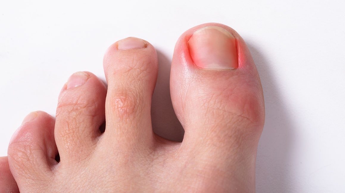 Chẩn đoán chín mé: Phân biệt chính xác để điều trị đúng hướng
