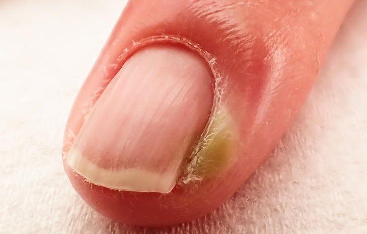 Chín mé là gì? Nhận diện tình trạng viêm quanh móng thường gặp